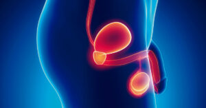 Cáncer de próstata en Colombia – mortalidad en hombres