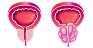 Hiperplasia prostática benigna en Barranquilla – síntomas y tratamiento